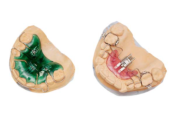 Palatal Expander Device (PED)